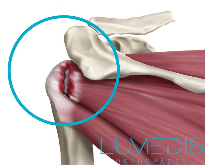 Ruptur der Infraspinatussehne