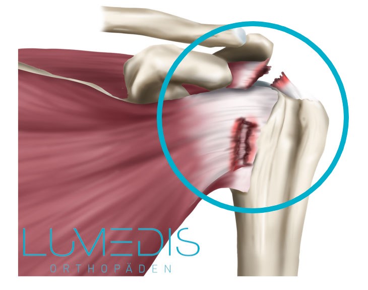 Ruptur Supraspinatusssehne Infraspinatussehne