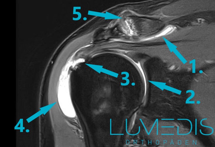 MRT einer Schleimbeutelentzündung der Schulter (Bursitis subdeltoidea)