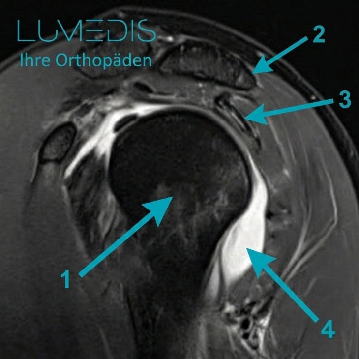 Ausgeprägte Bursitis subacromiales Ausgeprägte Bursitis subacromiales