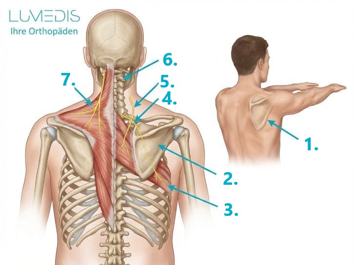 Abbildung einer Scapula alata Abbildung einer Scapula alata