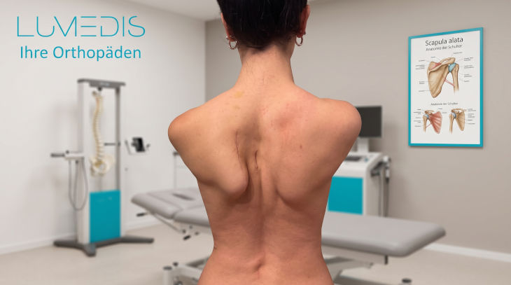 Scapula alata links mehr als rechts Scapula alata links mehr als rechts