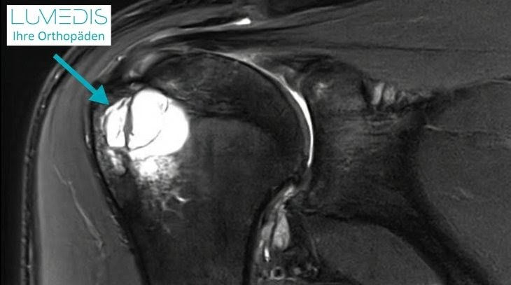 Zyste im Oberarmkopf