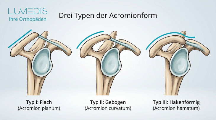 Acromion Typ 1, Acromion Typ 2, Acromion Typ 3 Acromion Typ 1, Acromion Typ 2, Acromion Typ 3