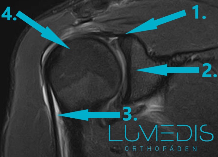 MRT einer rechten Schulter mit einer Entzündung der langen Bizepssehne