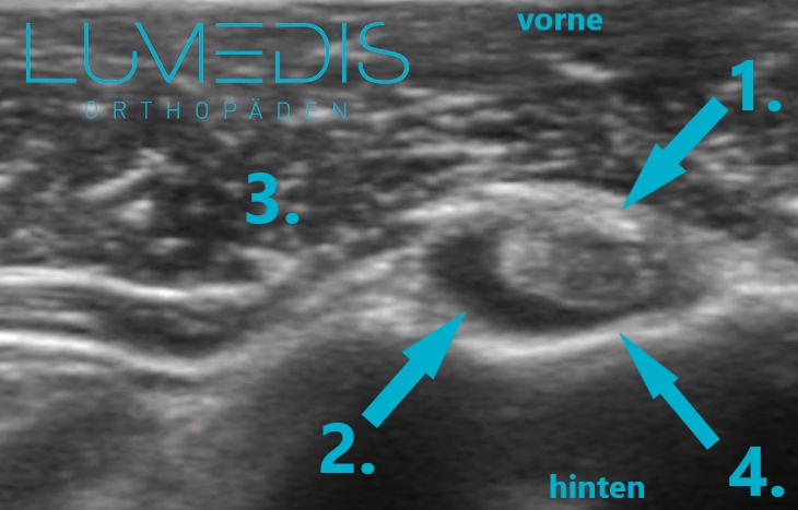 Ultraschallbild einer Bizepssehnenentzündung