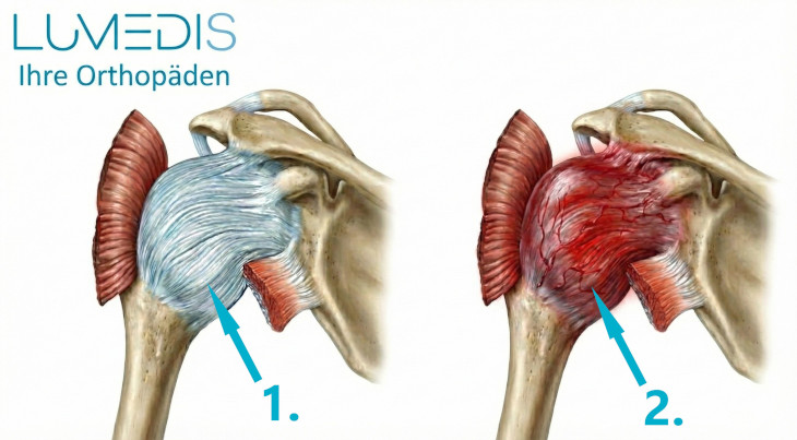 Abbildung einer gesunden und einer frozen Shoulder