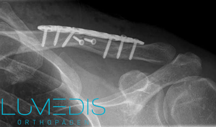 Röntgenbild eines gebrochenen Schlüsselbeins nach OP mit Platte und Schrauben Röntgenbild eines gebrochenen Schlüsselbeins nach OP mit Platte und Schrauben