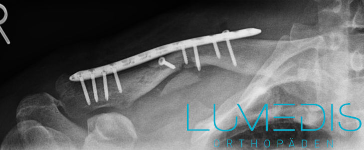 Schlüsselbeinbruch nach OP und Versorgung mit Platte und Schrauben Schlüsselbeinbruch nach OP und Versorgung mit Platte und Schrauben