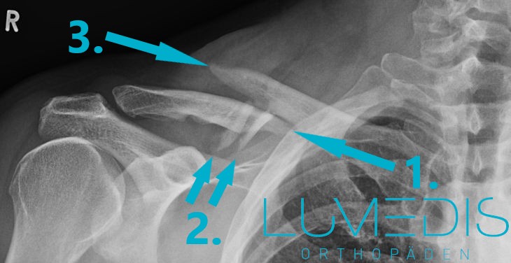 Schlüsselbeinbruch mit zwei freien Fragmenten Schlüsselbeinbruch mit zwei freien Fragmenten