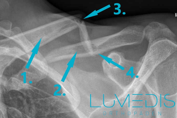 Röntgenbild eines gebrochenen Schlüsselbeins (Claviculafraktur) Röntgenbild eines gebrochenen Schlüsselbeins (Claviculafraktur)