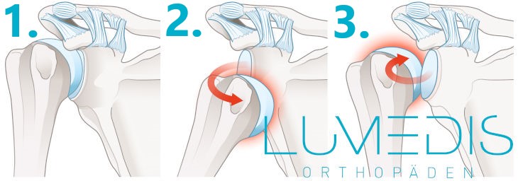 Abbildung einer vorderen und hinteren Schulterluxation (ausgekugelten Schulter)