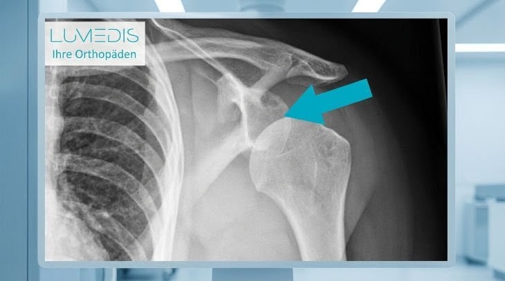 Röntgenbild einer vorderen Schulterluxation links