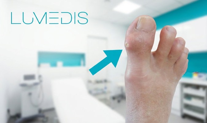 Gichttophus im Großzeh