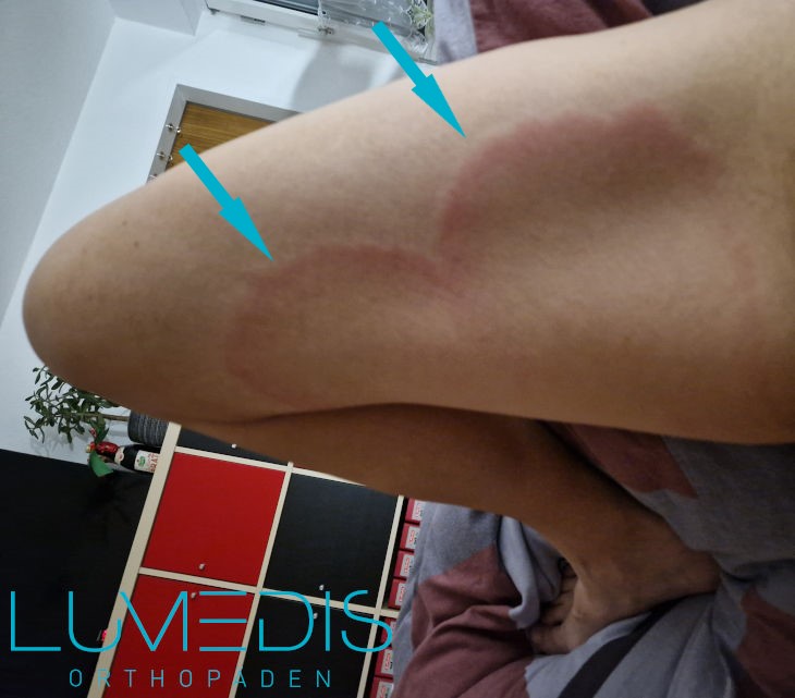 Bild einer Wanderröte (Erythema chronicum migrans) am Oberschenkel