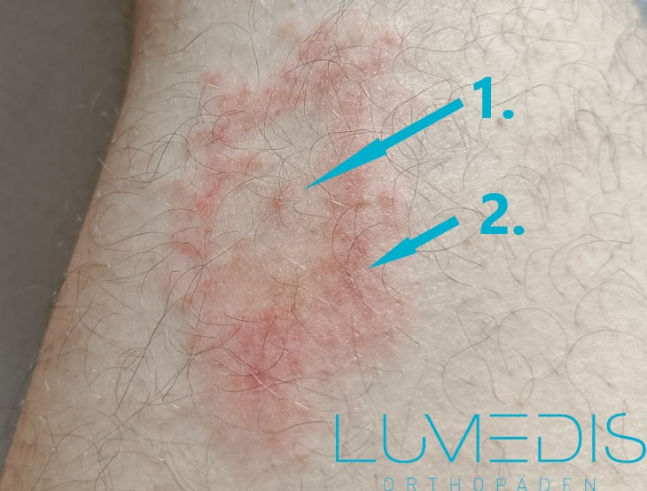 Borreliose, Wanderröte, Erythema chronicum migrans