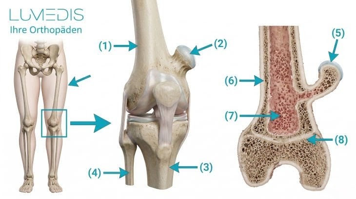 Abbildung eines Osteochondrom am Oberschenkelknochen