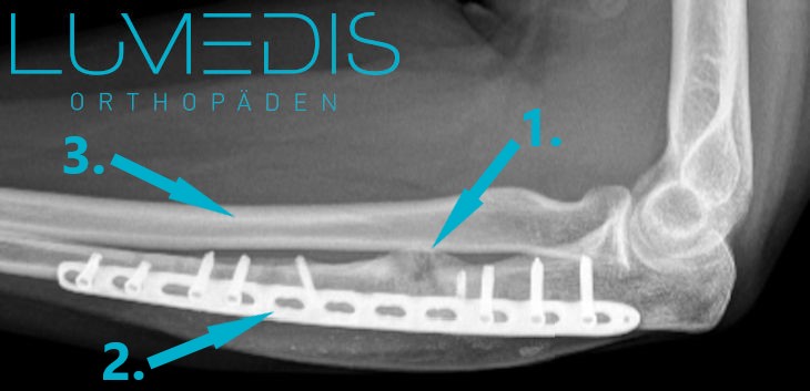 Pseudarthrose vor Behandlung (Ulna)
