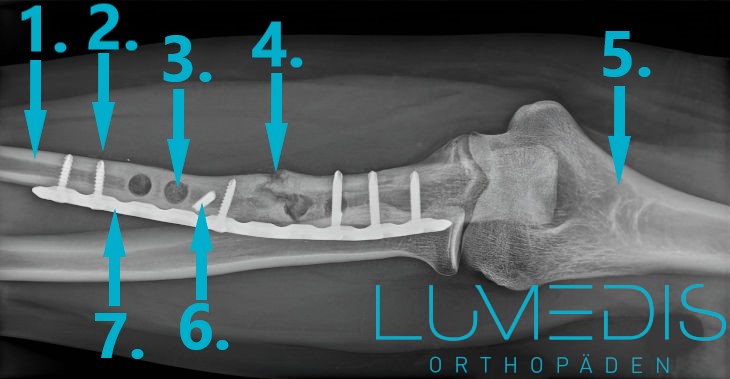 nicht heilender Unterarmbruch (Elle/Ulna)