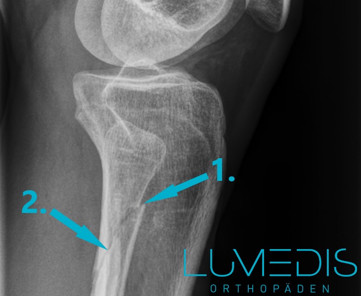 Röntgenbild eines Wadenbeinbruchs von der Seite