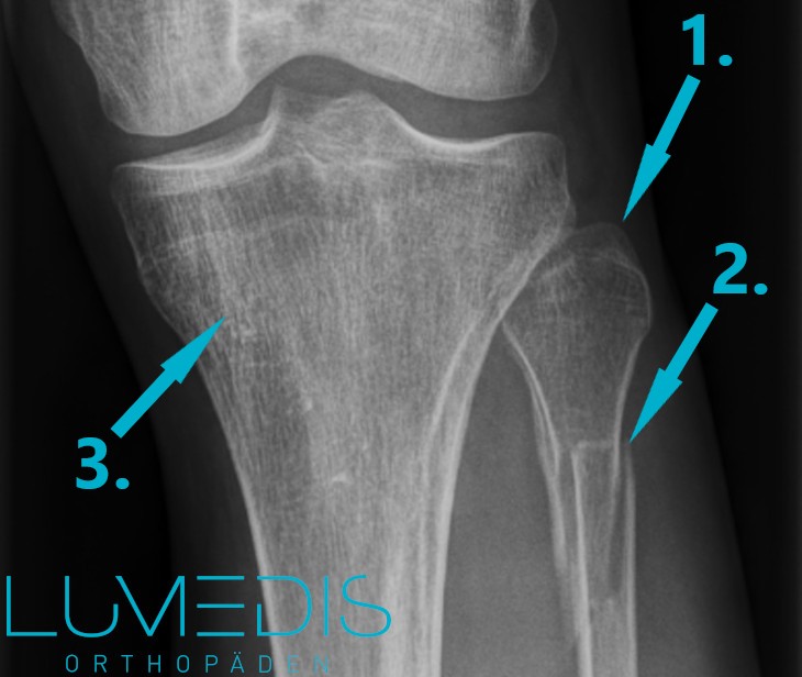 Röntgenbild eines Wadenbeinbruchs von vorne