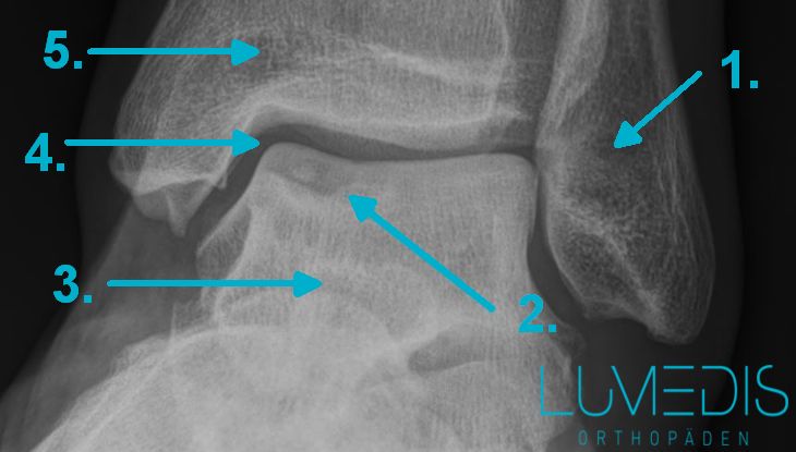 Osteochondrosis dissecans Sprunggelenk