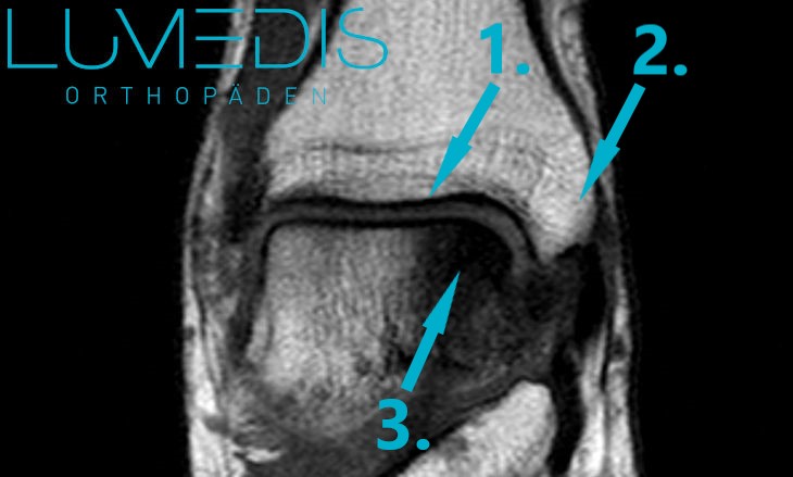 Osteochondrosis dissecans (OD) medialer Talus