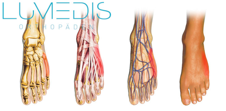 Fußschmerzen Außenkante