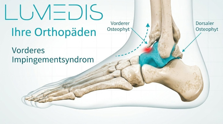 Vorderes Impingement im oberen Sprunggelenk