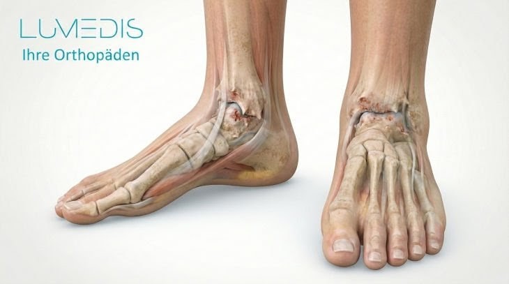 Abbildung einer Sprunggelenksarthrose
