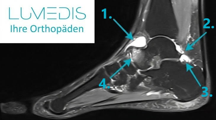 Wasser im oberen Sprunggelenk Wasser im oberen Sprunggelenk