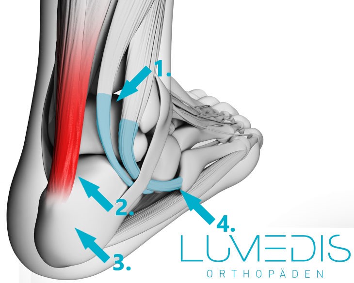 Achillessehnenentzündung