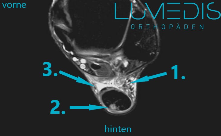 MRT einer angerissenen Achillessehne MRT einer angerissenen Achillessehne