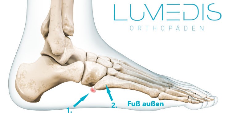 Os vesalianum, akzessorischer Fußknochen