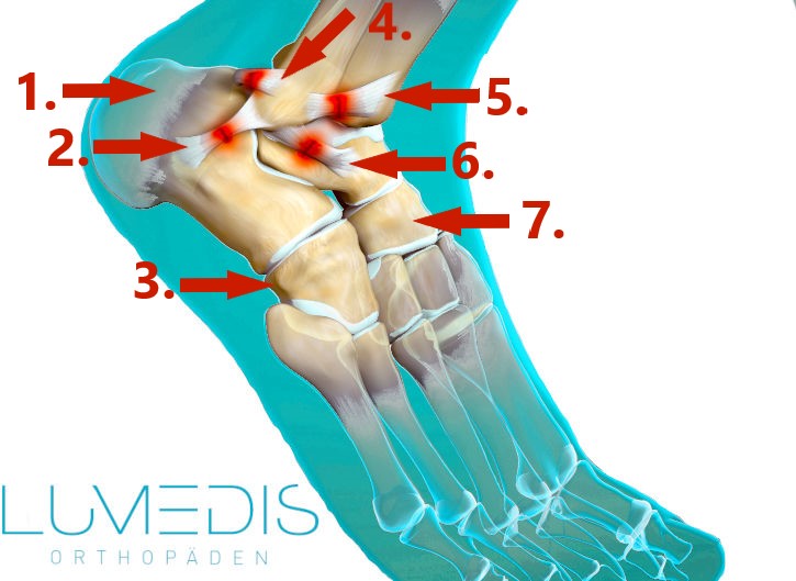 Bänderriss am Fuß