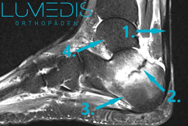 MRT eines unverschobenen Fersenbeinbruchs mit erheblichen Bone bruise