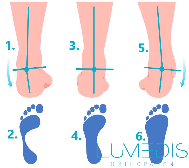 Fußfehlstellung mit Supinationsfehlstellung, Hohlfuß, normalen Fuß und Plattfuß mit Überpronation