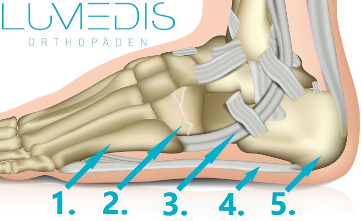 Bruch eines Fußwurzelknochens