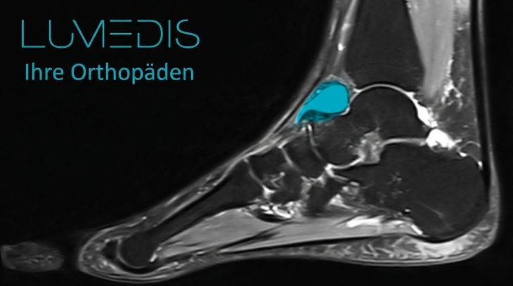 Ganglion am Fußrücken Ganglion am Fußrücken