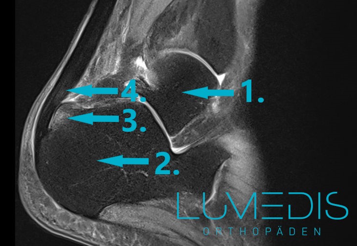 MRT eine Haglundferse mit bone bruise