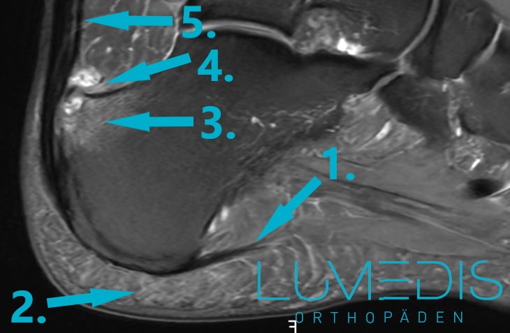 MRT einer Haglundferse mit bone bruise