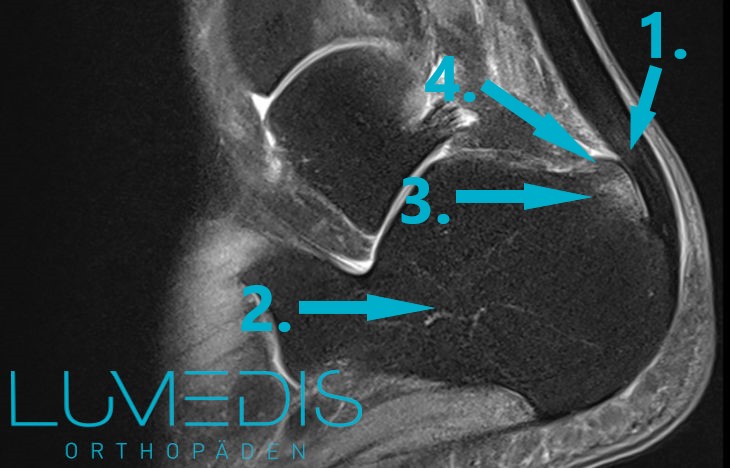 MRT einer Haglundferse mit Bone bruise