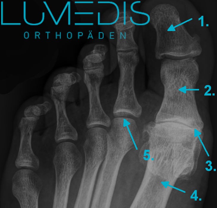 Röntgenbild eines Hallux rigidus