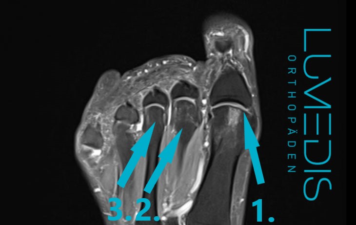 MRT eines Hallux rigidus