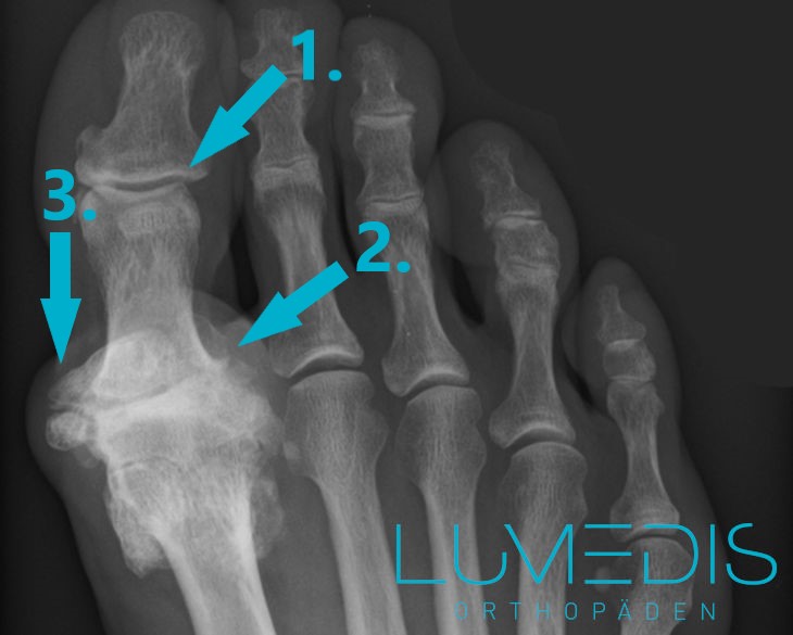 Röntgenbild eines Hallux rigidus