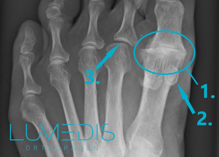 Hallux Valgus