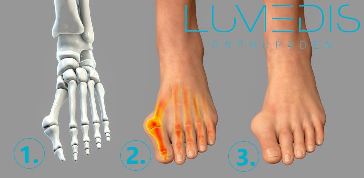 Abbildung Hallux valgus