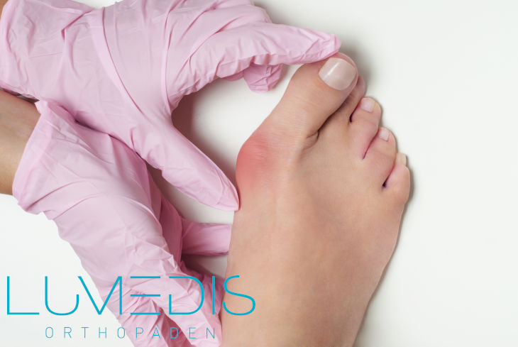 Hallux valgus