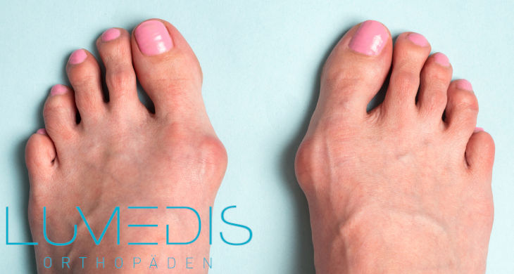 Hallux valgus