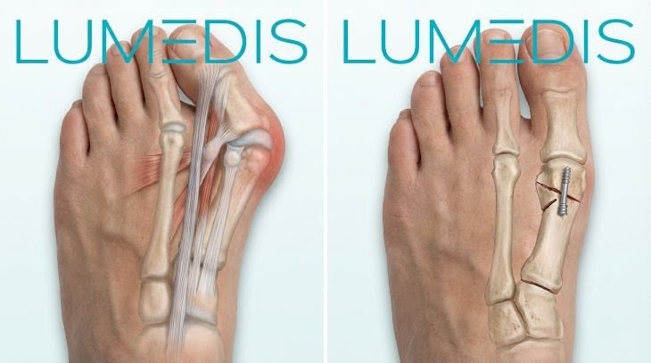 OP Hallux valgus nach Lumedis OP Hallux valgus nach Lumedis